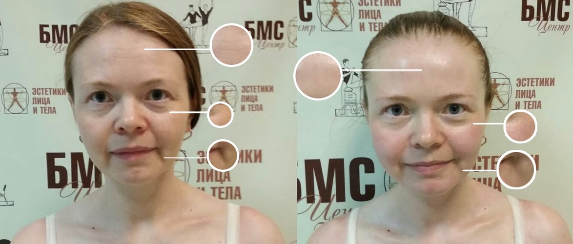 Аппарат Назарова: биомеханическаая стимуляция лица и тела, отзывы о БМС ...